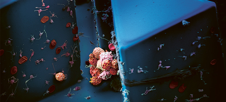 Klumpen aus zirkulierenden Tumorzellen (CTCs) einer Patientinmit metastasierendem Brustkrebs werden mit Hilfe eines selbstentwickelten Mikrofluidik-Chips (blau) isoliert. Als Vergleichsgrössedienen rote Blutkörperchen (7.5 μm, rot). Vergrösserung: ca. 1000-fach.© Martin Oeggerli und Ali Faith Sarioglu